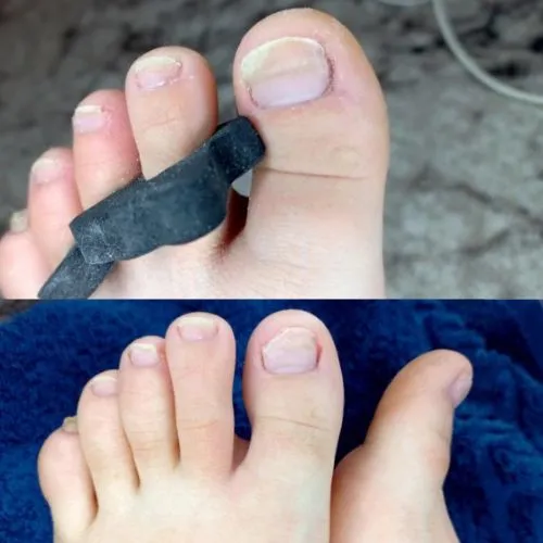 Reconstruction esthétique ongle pied abîmé avec capsules.
